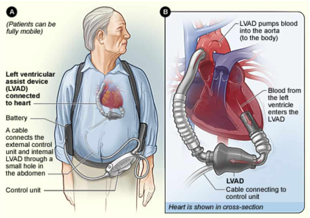 How is heart failure treated?