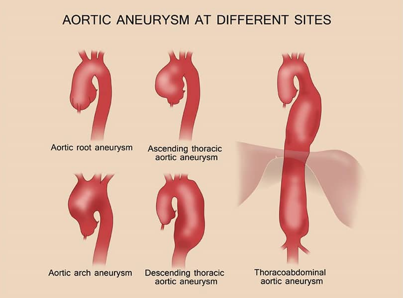 What causes an aortic aneurysm or dissection?